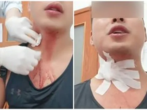 Khó tin: Nhập viện do vỡ tĩnh mạch sau khi cố đập... muỗi