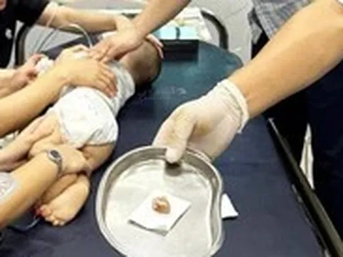 Bé trai 16 tháng tuổi tím tái, suy hô hấp vì hóc hạt chôm chôm