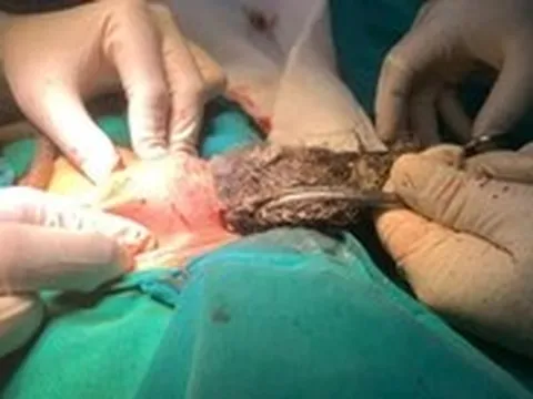 Bé 46 tháng tuổi nuốt búi tóc dài 20cm trong dạ dày