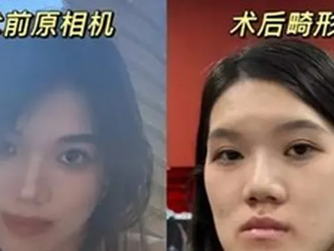 Nữ người mẫu 24 tuổi phẫu thuật thẩm mỹ từ bị móm nhẹ thành mặt lưỡi cày: Lời giải thích của bác sĩ gây phẫn nộ