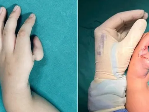 Bé gái được ‘tạo ngón cái mới’ từ ngón trỏ