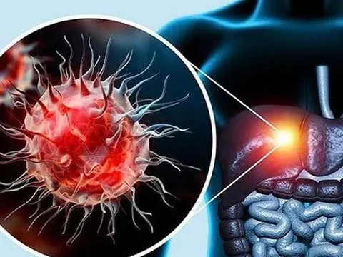 Không rượu bia, gan vẫn có thể tổn thương nặng vì lý do ít ai ngờ