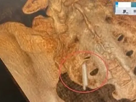 Đi khám sức khỏe, cô gái sốc khi phát hiện thứ "bất ngờ" nằm trong cơ thể suốt 22 năm