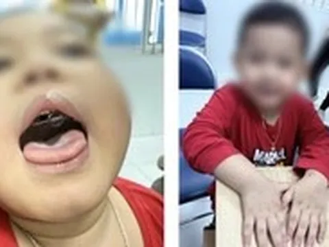 Ngưng thở khi ngủ kéo dài, bé trai tím tái cả khi thức suốt 2 năm