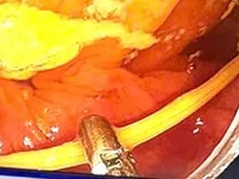 Đau bụng kéo dài, đi khám thì phát hiện que tăm 6,5cm gây thủng ruột non