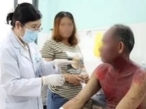 Người đàn ông bị hoại tử thượng bì nhiễm độc nặng sau dùng thuốc nhỏ mắt