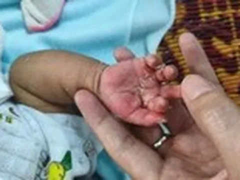 Trẻ 2 tháng tuổi mắc giang mai bẩm sinh, dễ nhầm bệnh ngoài da