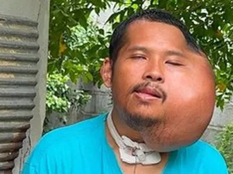Xỉa răng sai cách, người đàn ông 31 tuổi có khuôn mặt "đáng sợ"