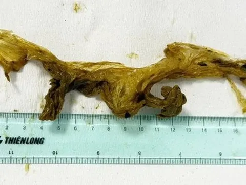 Hy hữu: Đau bụng, nội soi phát hiện trong ruột non có túi ni lông dài 20cm