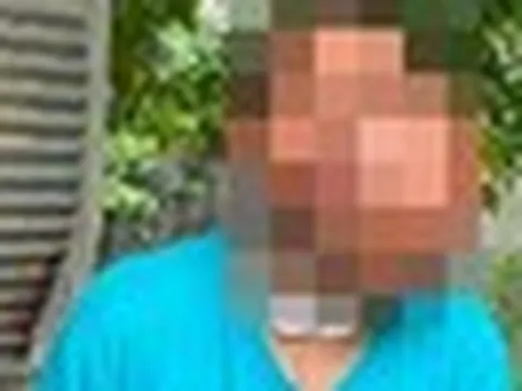 Người đàn ông 31 tuổi biến dạng khuôn mặt đến khó tin sau thời gian thường xuyên dùng tăm xỉa răng