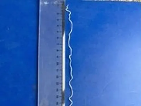 Tự nặn mụn trên cánh tay, phát hiện con giun rồng dài 20cm dưới da