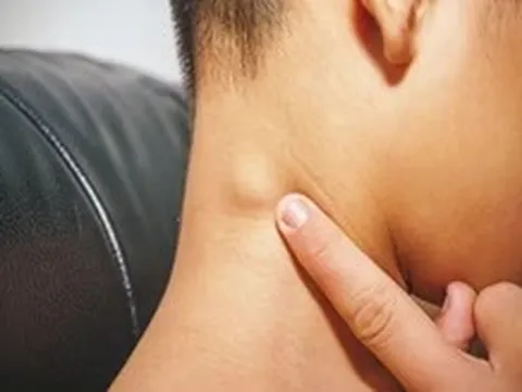 Sáng ngủ dậy thấy hạch bạch huyết bất ngờ sưng to, vì sao?