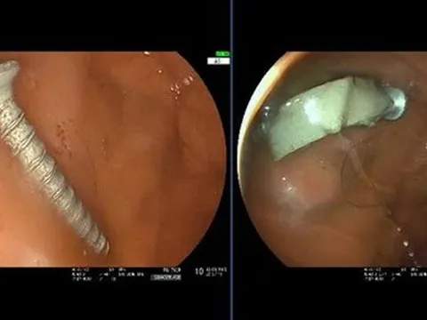 Cứu bé gái 11 tháng tuổi nuốt phải đinh vít dài 4cm