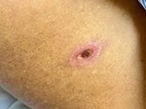 Phát hiện bệnh từ một vết loét nhỏ