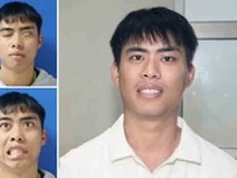 Phục hồi thành công gương mặt cho nam thanh niên liệt mặt suốt 7 năm