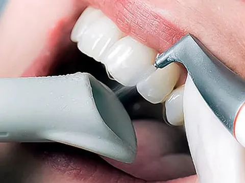 Vệ sinh răng sứ đúng cách để sau phục hình răng đảm bảo bền đẹp lâu dài