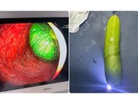 Nam sinh lớp 9 nhập viện vì 'nghịch dại', đưa quả dưa chuột dài 20cm vào hậu môn