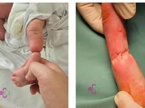 Hy hữu: Trẻ sơ sinh bị vòng xơ thắt nghẹt cẳng chân từ trong bụng mẹ