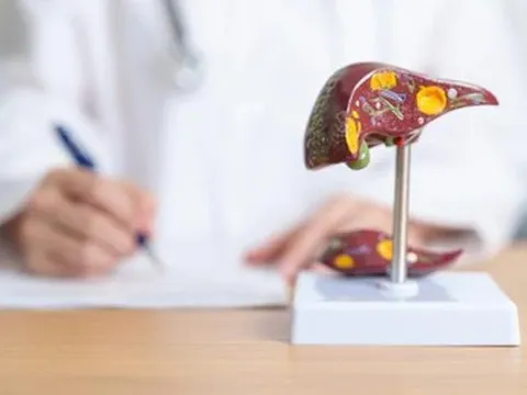 Thuốc bổ gan, giải độc gan có chữa được gan nhiễm mỡ?