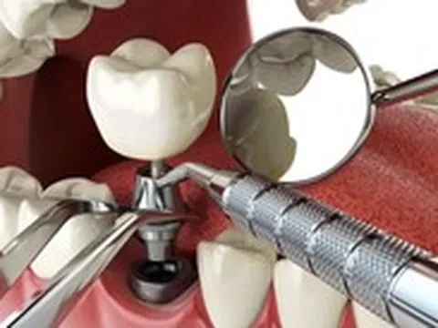 Người bệnh đái tháo đường có nên cấy implant ngay sau khi nhổ răng?