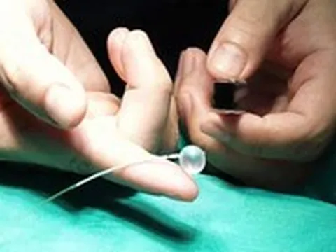 Lần đầu tiên tại Việt Nam: Đặt bóng vào khí quản thai nhi 30 tuần tuổi, cứu trẻ từ trong bụng mẹ
