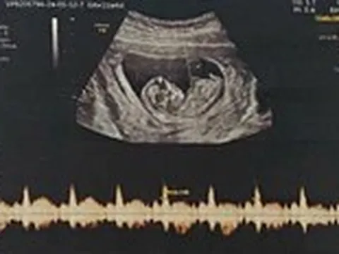 Mất cân bằng giới tính khi sinh: Cần siết việc xử phạt hành vi lựa chọn giới tính