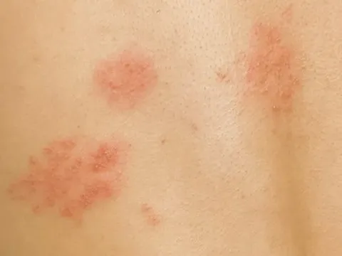 Da đã lành, cơn đau sau zona thần kinh vẫn gây mất ngủ, trầm cảm