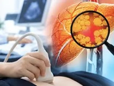 Tập thể thao, ít rượu bia vẫn bị gan nhiễm mỡ vì thói quen tưởng chừng lành mạnh