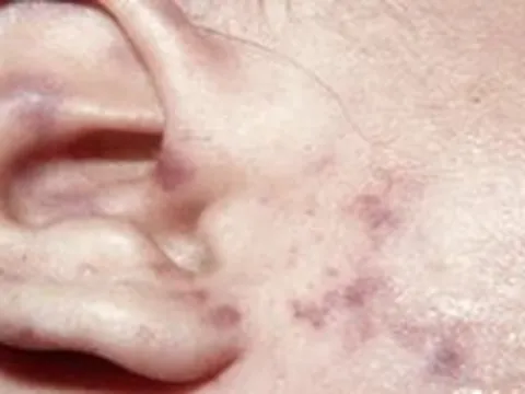 Chuyên gia lý giải vì sao bệnh do não mô cầu ít gặp, vẫn cần chủ động kiểm soát từ đầu